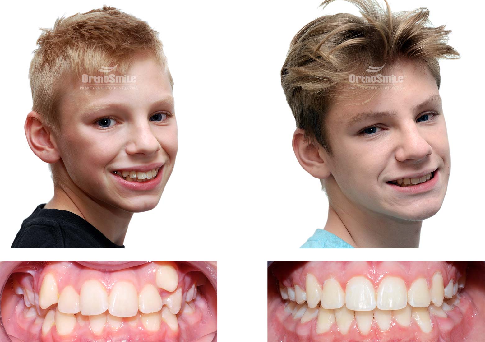 Przykład leczenia stłoczeń aparatem stałym u młodzieży. Leczenie ortodontyczne dzieci – metamorfozy. Praktyka Ortodontyczna Orthosmile, Wrocław