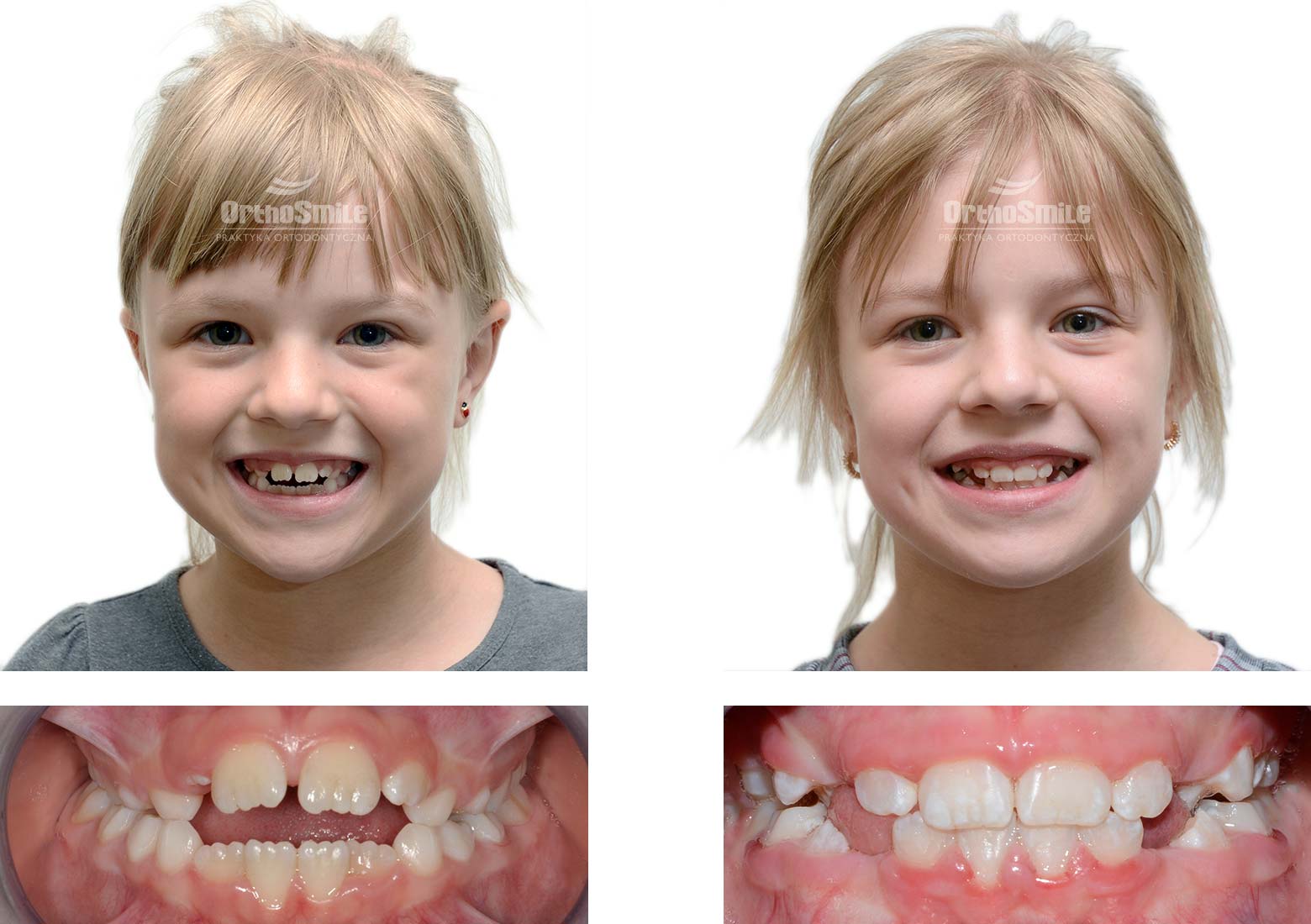 Dziewięcioletnia pacjentka ze zgryzem otwartym, leczona fragmentarycznym aparatem stałym. Leczenie ortodontyczne dzieci – metamorfozy. Praktyka Ortodontyczna Orthosmile, Wrocław