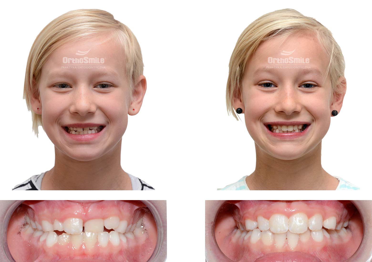 Dziecko ze zgryzem krzyżowym leczone aparatem fragmentarycznym typu Damon. Czas leczenia około 12 miesięcy. Leczenie ortodontyczne dzieci – metamorfozy. Praktyka Ortodontyczna Orthosmile, Wrocław