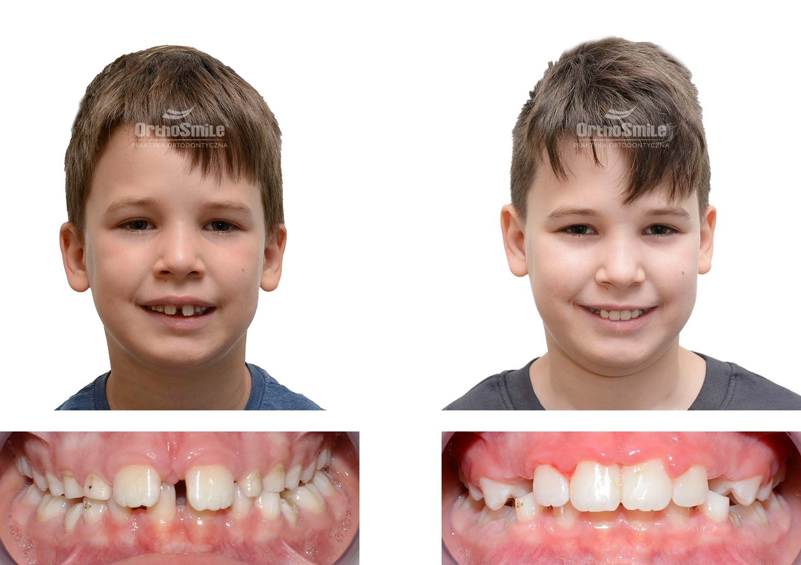 Leczenie ortodontyczne dzieci – metamorfozy. Praktyka Ortodontyczna Orthosmile, Wrocław