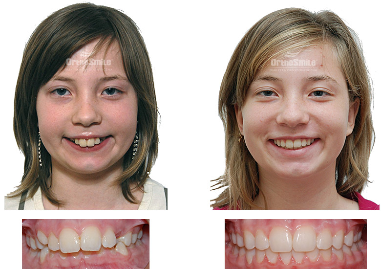 Leczenie ortodontyczne dzieci – metamorfozy. Praktyka Ortodontyczna Orthosmile, Wrocław