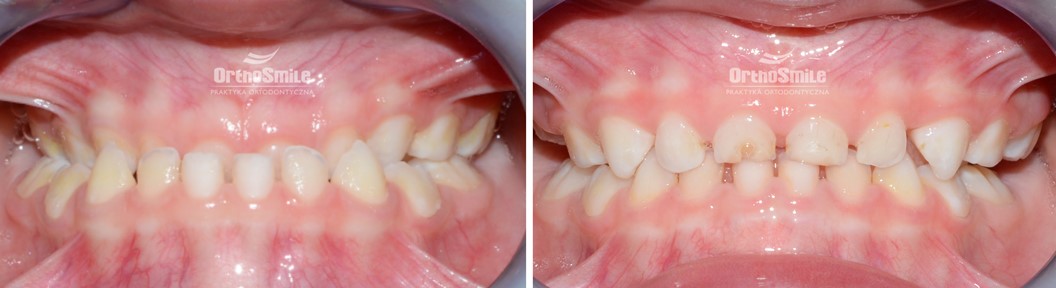 Praktyka Ortodontyczna Orthosmile, Wrocław. Progenia. III klasa. BAMP. Hyrax. Hyrax hybrydowy. Maska twarzowa. Maska Delaire.
