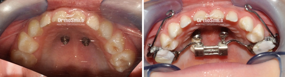 Praktyka Ortodontyczna Orthosmile, Wrocław. Progenia. III klasa. BAMP. Hyrax. Hyrax hybrydowy. Maska twarzowa. Maska Delaire.
