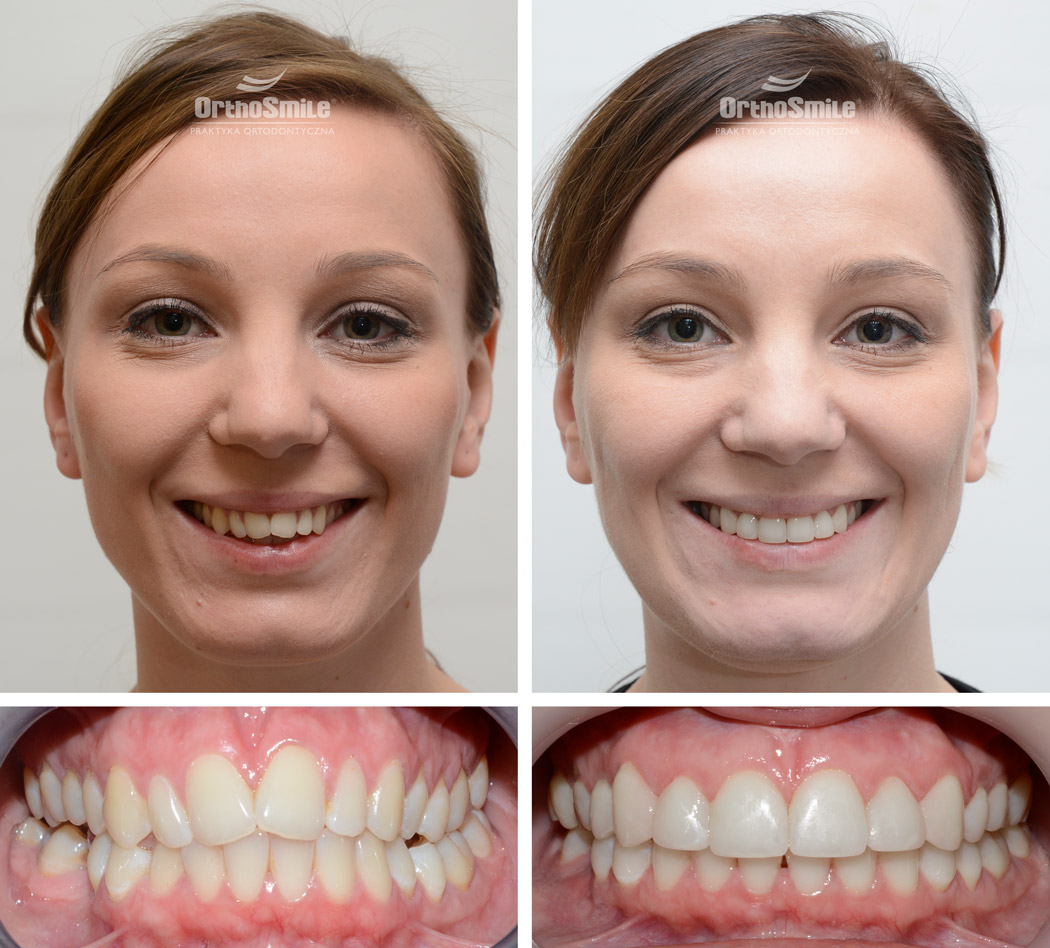 ortodoncja ortodonta wrocław wroclaw orthodontics orthodontist aparat stały system damon
