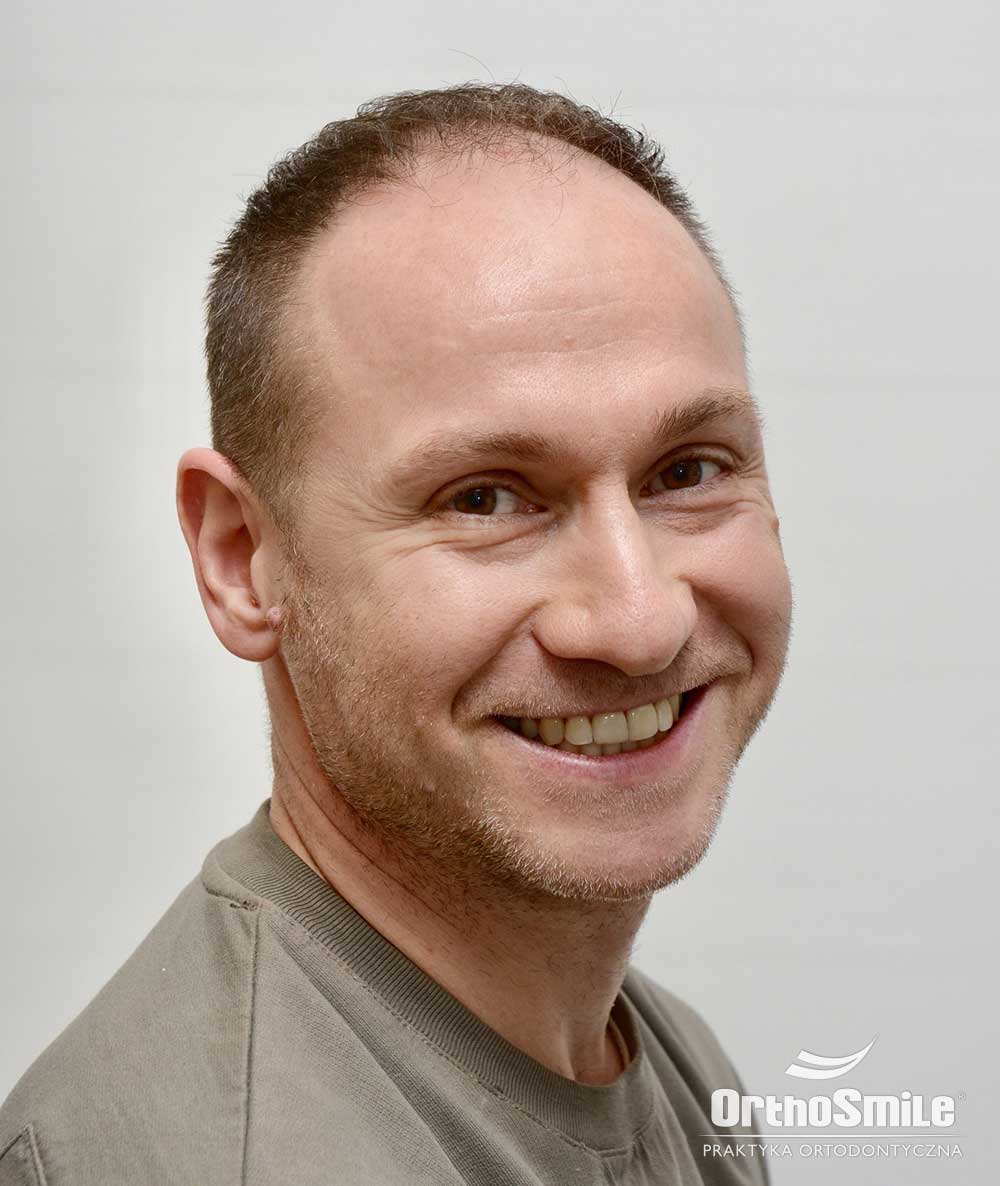 Praktyka Ortodontyczna Orthosmile, Wrocław. Pacjent po zakończeniu trudnego leczenia.
