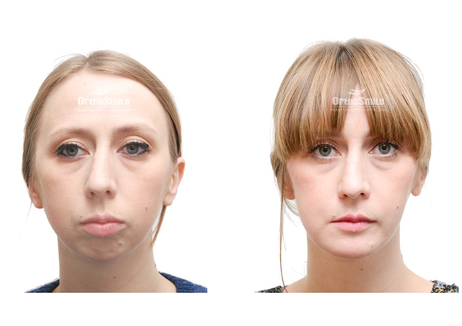 Praktyka Ortodontyczna Orthosmile, Wrocław. Pacjentka ze szkieletową wadą klasy II i zgryzem otwartym leczona zespołowo ortodontyczno-chirurgicznie. Ortodoncja: Dr n.med. Alina Strzałkowska, chirurgia: Dr n.med. Rafał Nowak.