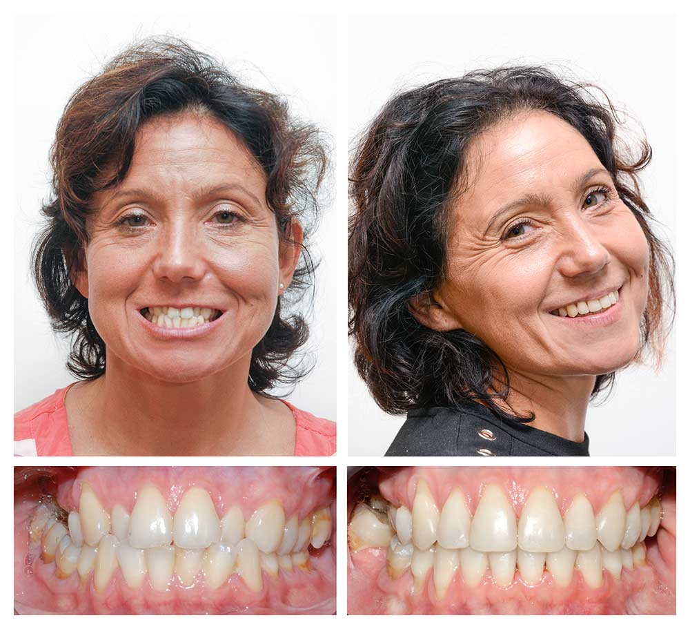 Zdjęcie pacjentki z wadą klasy III i stłoczeniami, leczona zachowawczo aparatem ortodontycznym, metodą bezekstrakcyjną.