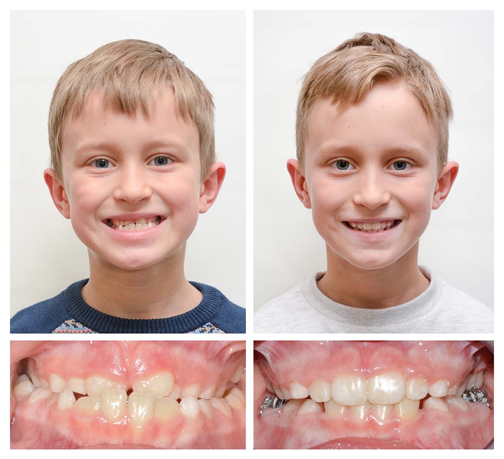 Zdjęcie pacjenta przed i po leczeniu.