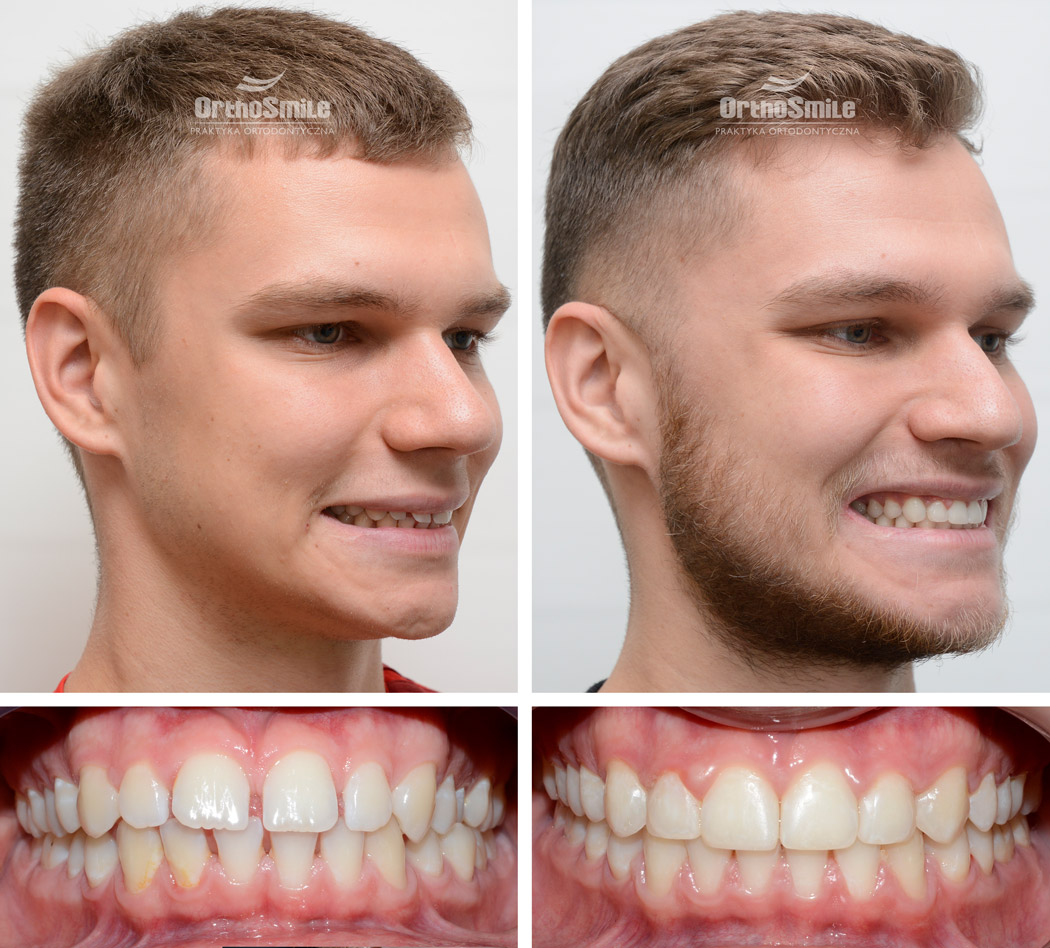 #ortodoncja #ortodoncjawroclaw #operacjatwarzy #chirurgiatwarzy #wadazgryzu #pieknyusmiech #klinika #wroclaw #metamorfoza #orthosmile #smile