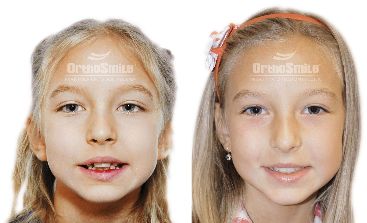 Praktyka Ortodontyczna Orthosmile, Wrocław: złe nawyki, ssanie palca, aparat fragmentaryczny, ortodoncja, leczenie wczesne