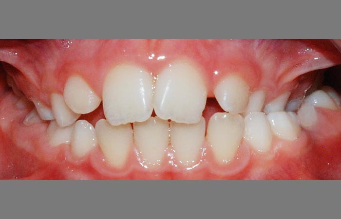 Praktyka Ortodontyczna Orthosmile, Wrocław: ssanie palca, ortodoncja, złe nawyki, wady zgryzu