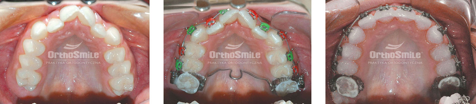 Praktyka Ortodontyczna Orthosmile, Wrocław: przerzut podniebienny TPA, aparat fragmentaryczny, zwężenie szczęki, ortodoncja