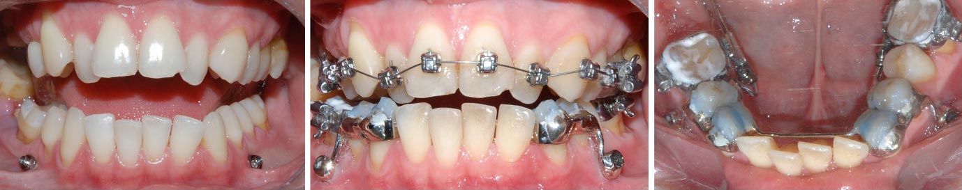 Beneslider, aparaty stałe, ortodoncja, poszerzanie szczęk, zwężenie szczęk
