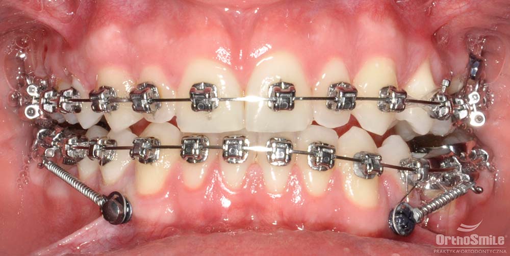 Praktyka Ortodontyczna Orthosmile, Wrocław: miniimplanty ortodontyczne, mikroimplanty, zakotwienie maksymalne, aparaty stałe, wyciąg elastyczny