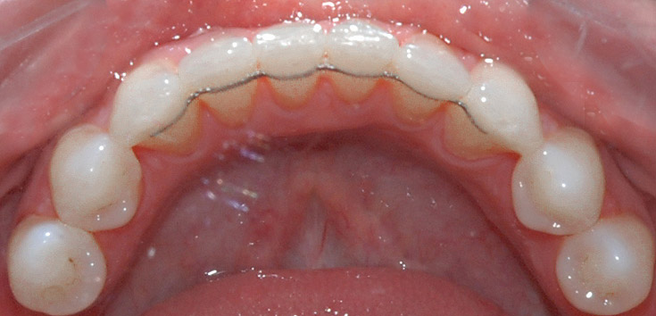 reitainer, ortodoncja, stabilizacja wyników leczenia, drut od strony języka, retencja