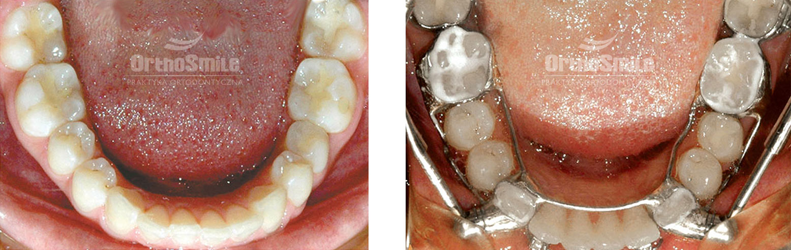 zawias Herbsta, leczenie zespołowe, leczenie ortodontyczne, aparat stały, rzut szczęk przed i po leczeniu ortodontycznym, leczenie tyłozgryzu