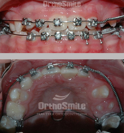 autotransplantacja zęba, zgryz przed i po leczeniu ortodontycznym