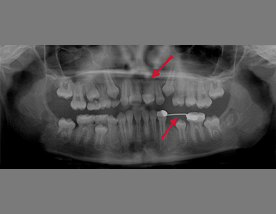 autotransplantacja zęba, zgryz przed i po leczeniu ortodontycznym