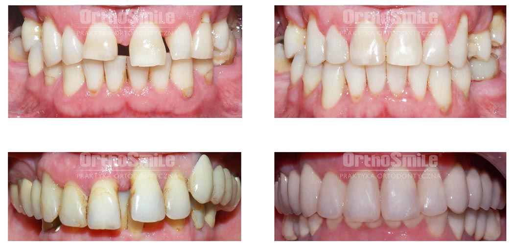 Praktyka Ortodontyczna Orthosmile, Wrocław: choroby przyzębia, paradontoza, szparowatość łuków zębowych, przechylanie zębów, efekt Godona, zgryz przed i po leczeniu ortodontycznym aparatami stałymi, odbudowy kompozytowe