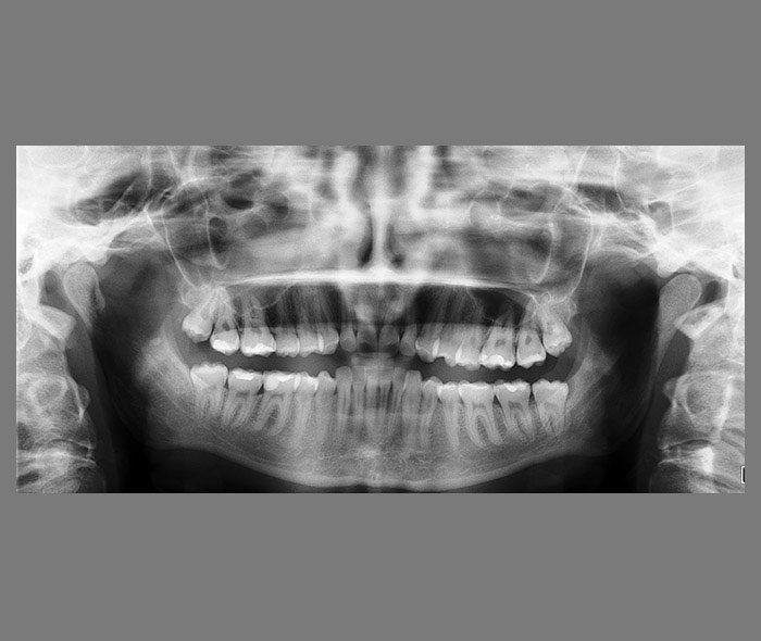 Praktyka Ortodontyczna Orthosmile, Wrocław: ortodoncja, badanie diagnostyczne w gabinecie ortodontycznym, zdjęcie pantomograficzne – panoramiczne
