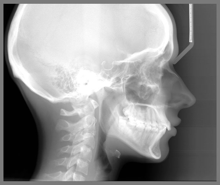 Praktyka Ortodontyczna Orthosmile, Wrocław: ortodoncja, analiza cefalometryczna, pomiar cefalo, zdjęcie cefalometryczne czaszki