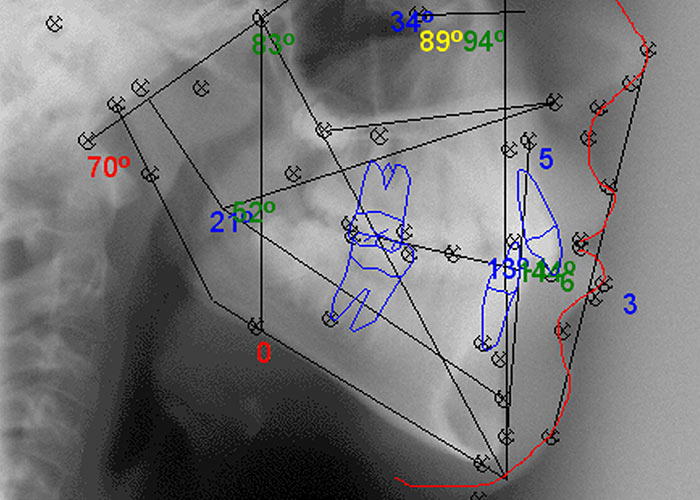 Praktyka Ortodontyczna Orthosmile, Wrocław: analiza cefalometryczna, pomiar cefalo, zdjęcie cefalometryczne