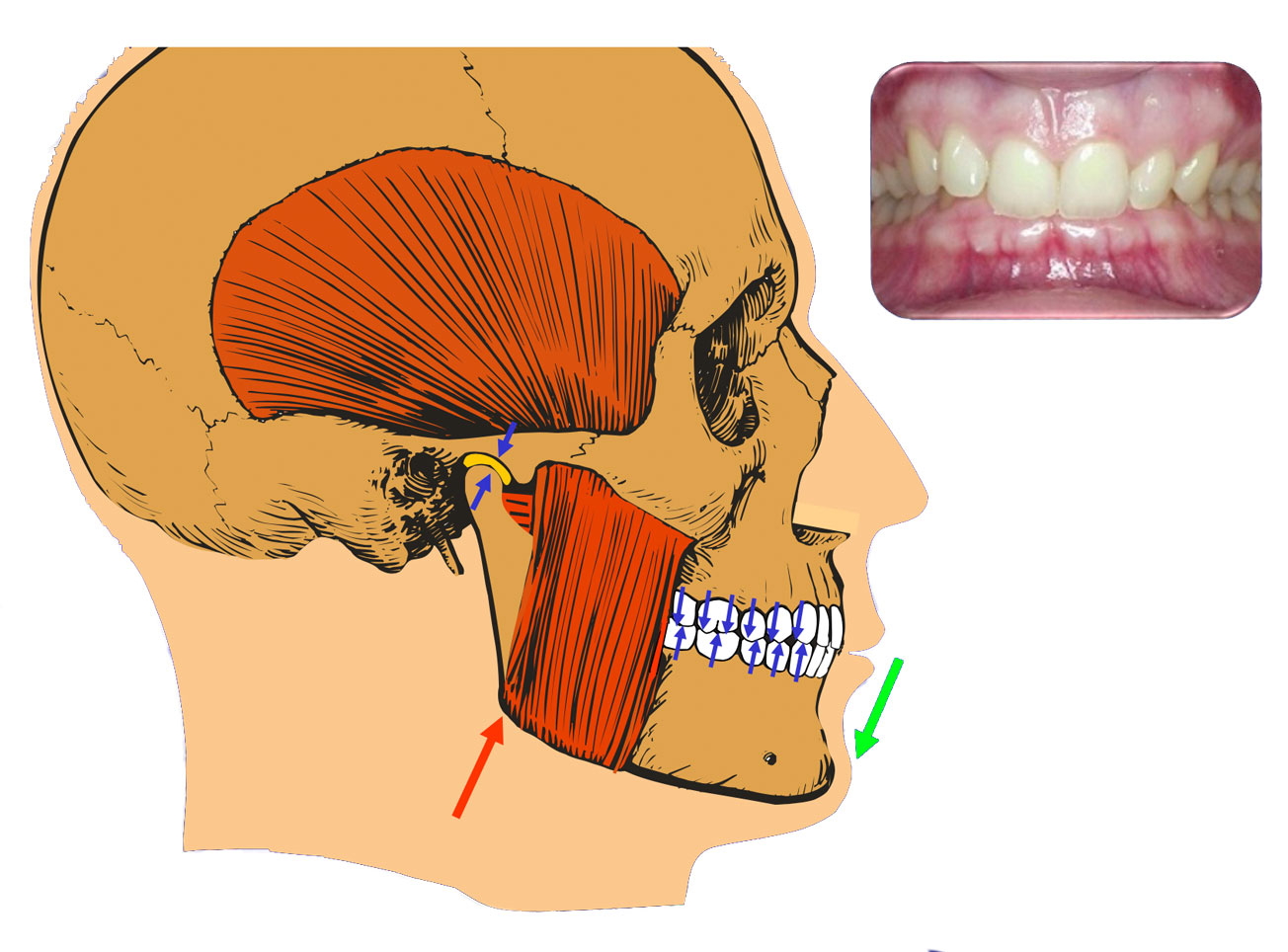 Praktyka Ortodontyczna Orthosmile, Wrocław: Zgodność maksymalnego zaguzkowania zębów z centralną relacją w stawach skroniowo-żuchwowych. Ilustracja dzięki uprzejmości prof. Jeffrey’a Okesona