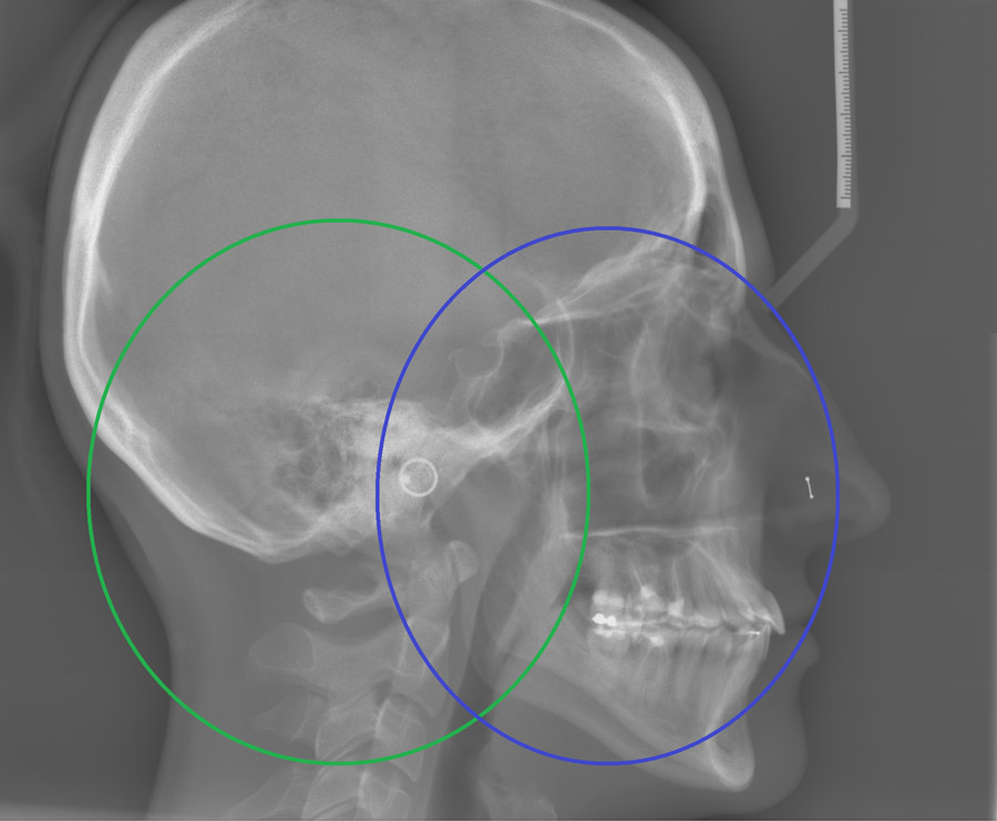 Praktyka Ortodontyczna Orthosmile, Wrocław: Centralna relacja czaszkowo-żuchwowa i czaszkowo-kręgowa - ujęcie boczne