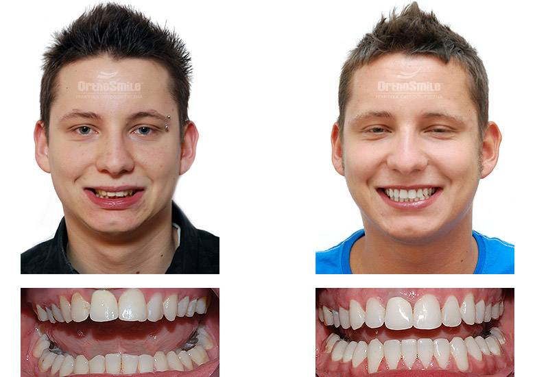 Leczenie ortodontyczne i chirurgiczne – metamorfozy. Praktyka Ortodontyczna Orthosmile, Wrocław