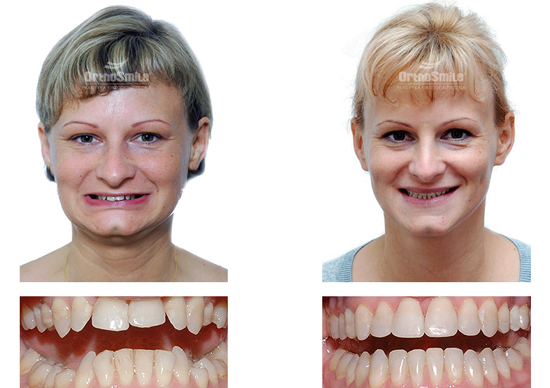 Leczenie ortodontyczne i chirurgiczne – metamorfozy. Praktyka Ortodontyczna Orthosmile, Wrocław