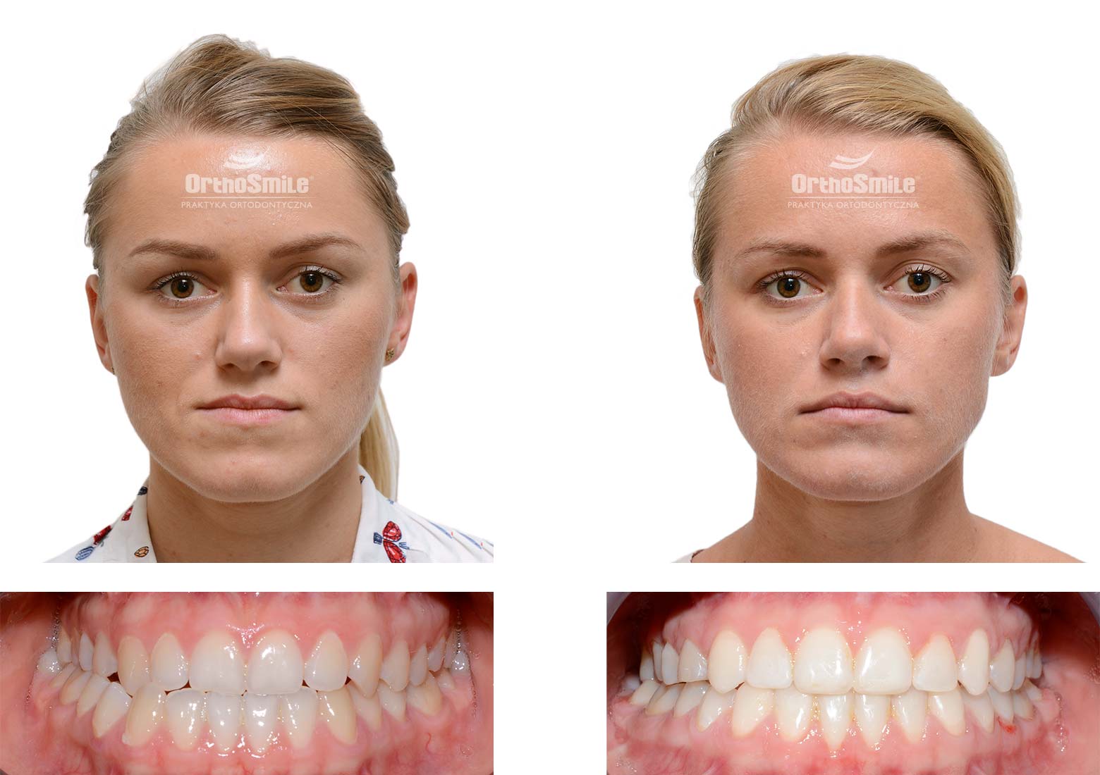 Leczenie ortodontyczne i chirurgiczne – metamorfozy. Praktyka Ortodontyczna Orthosmile, Wrocław