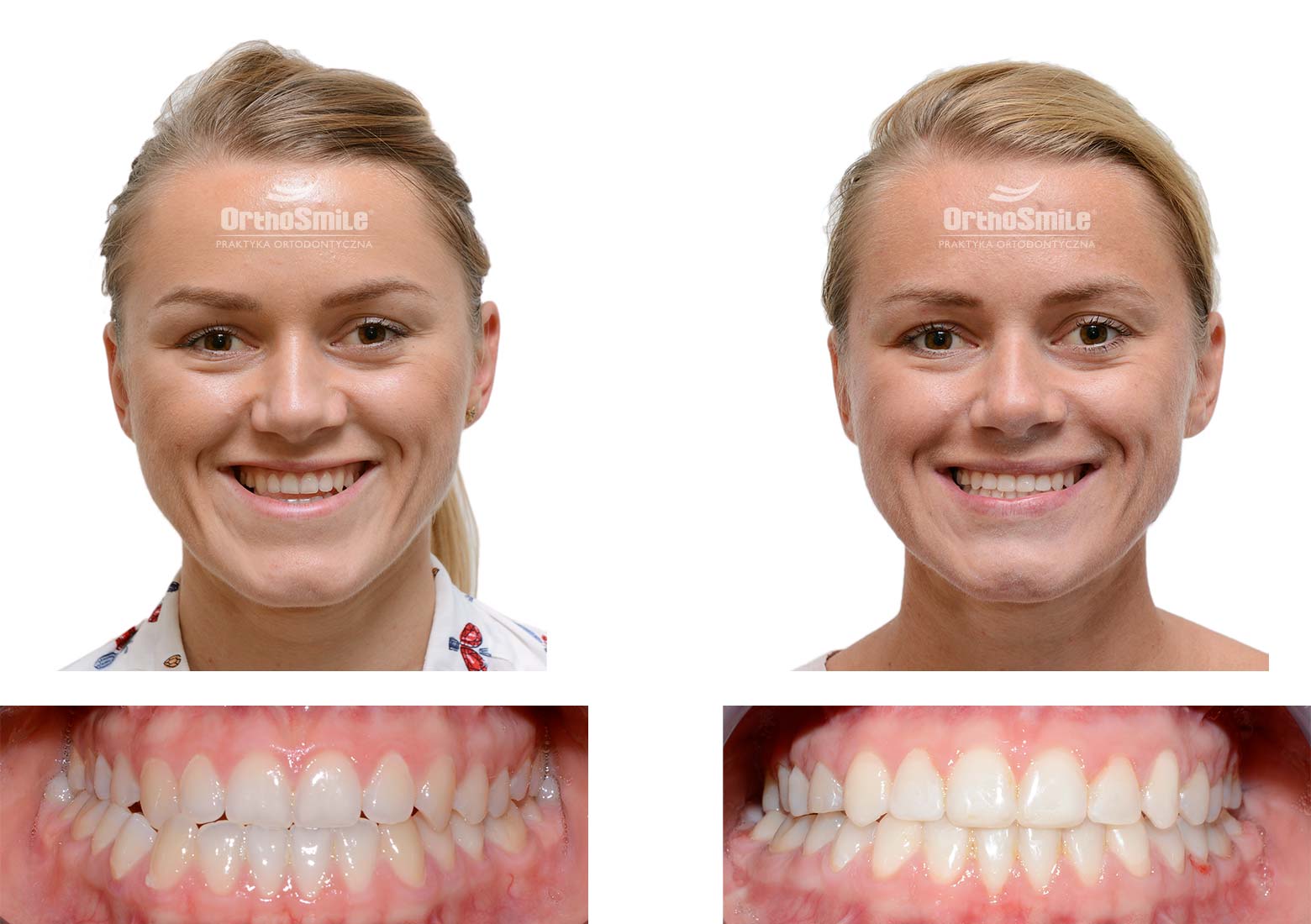 Leczenie ortodontyczne i chirurgiczne – metamorfozy. Praktyka Ortodontyczna Orthosmile, Wrocław