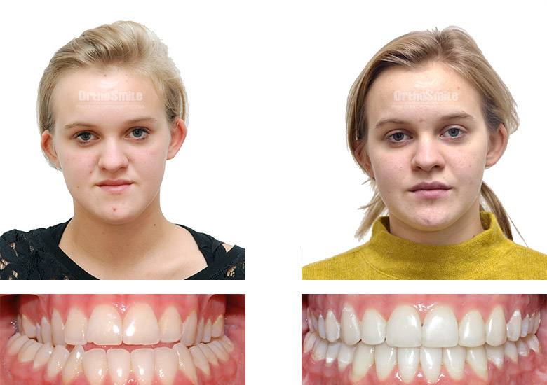 Leczenie ortodontyczne i chirurgiczne – metamorfozy. Praktyka Ortodontyczna Orthosmile, Wrocław