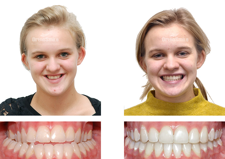 Leczenie ortodontyczne i chirurgiczne – metamorfozy. Praktyka Ortodontyczna Orthosmile, Wrocław