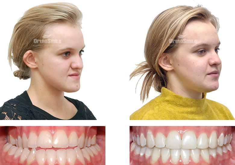 Leczenie ortodontyczne i chirurgiczne – metamorfozy. Praktyka Ortodontyczna Orthosmile, Wrocław