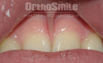 przerost wędzidła, podcięcie wędzidła wargi górnej, korekta wędzidła, frenuloplastyka, ortodoncja, diastema