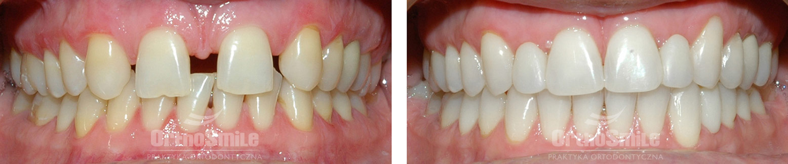 diastema prawdziwa, vera, frenulaplastyka, podcięcie wędzidła, leczenie ortodontyczne