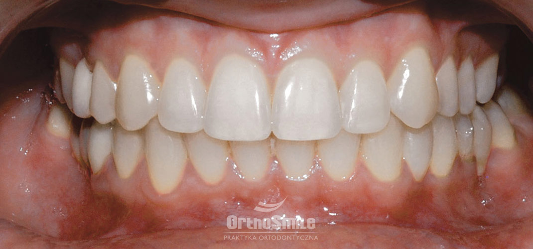 wyniki leczenia ortodontycznego, ładny prawidłowy zgryz, odbudowy kompozytowe siekaczy górnych