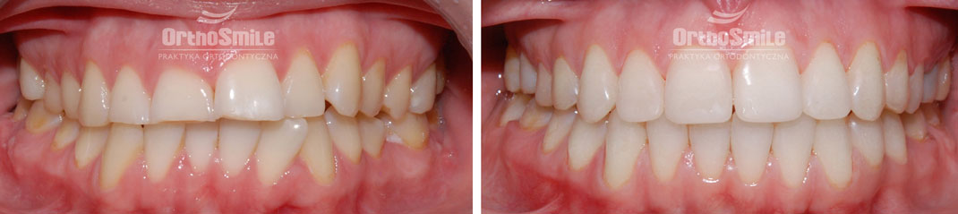 zgryz przed i po leczeniu ortodontycznym, prace protetyczne, odbudowy kompozytowe