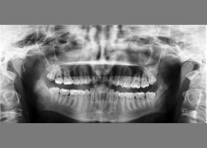 ortodoncja, badanie diagnostyczne w gabinecie ortodontycznym, zdjęcie pantomograficzne – panoramiczne