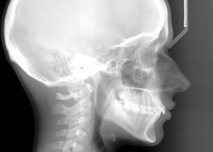 ortodoncja, analiza cefalometryczna, pomiar cefalo, zdjęcie cefalometryczne czaszki