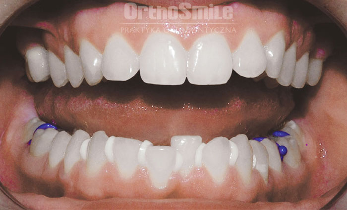 Separacja ortodontyczna