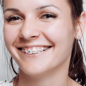 Aparat ortodontyczny – czy warto?