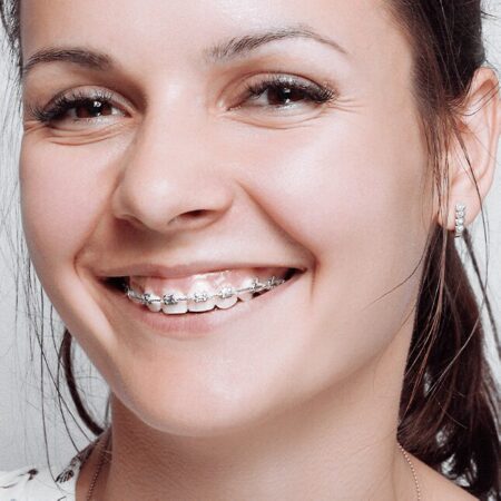 Aparat ortodontyczny – czy warto?