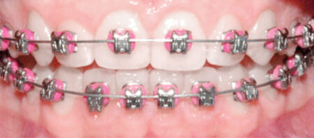 FOTO_SEKCJA_8-ZABIEGI-FRENULOPLASTYKA_4